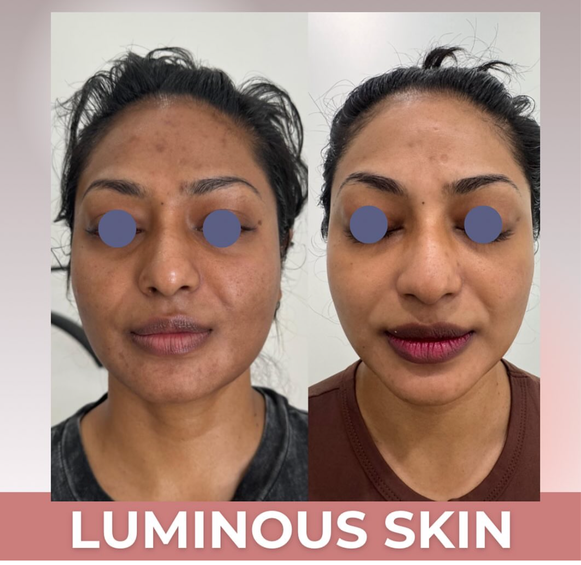 LIFT Brighten & Tighten Package