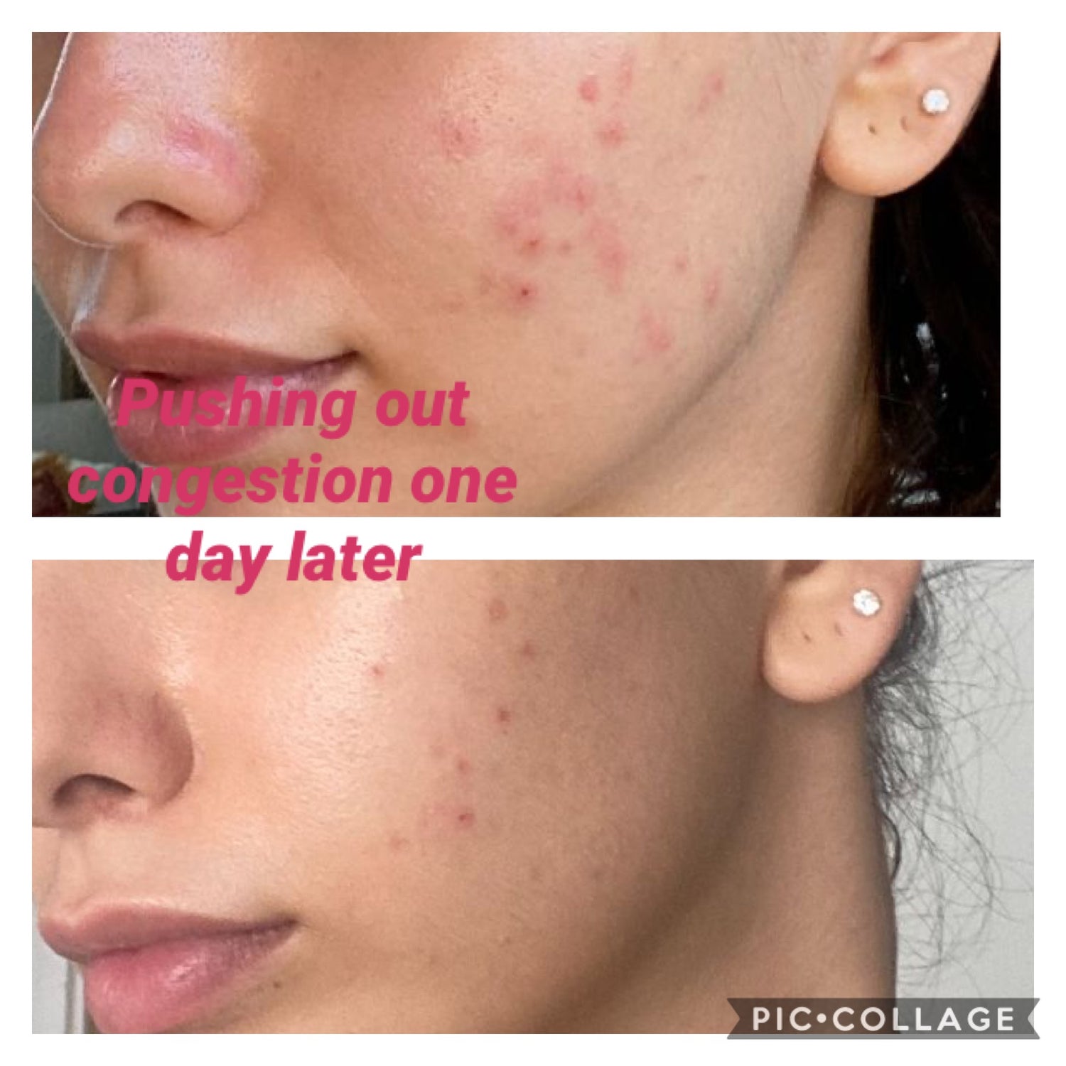 5x Carboxy Korean Facial plus HYDRA deep clean & Led Light