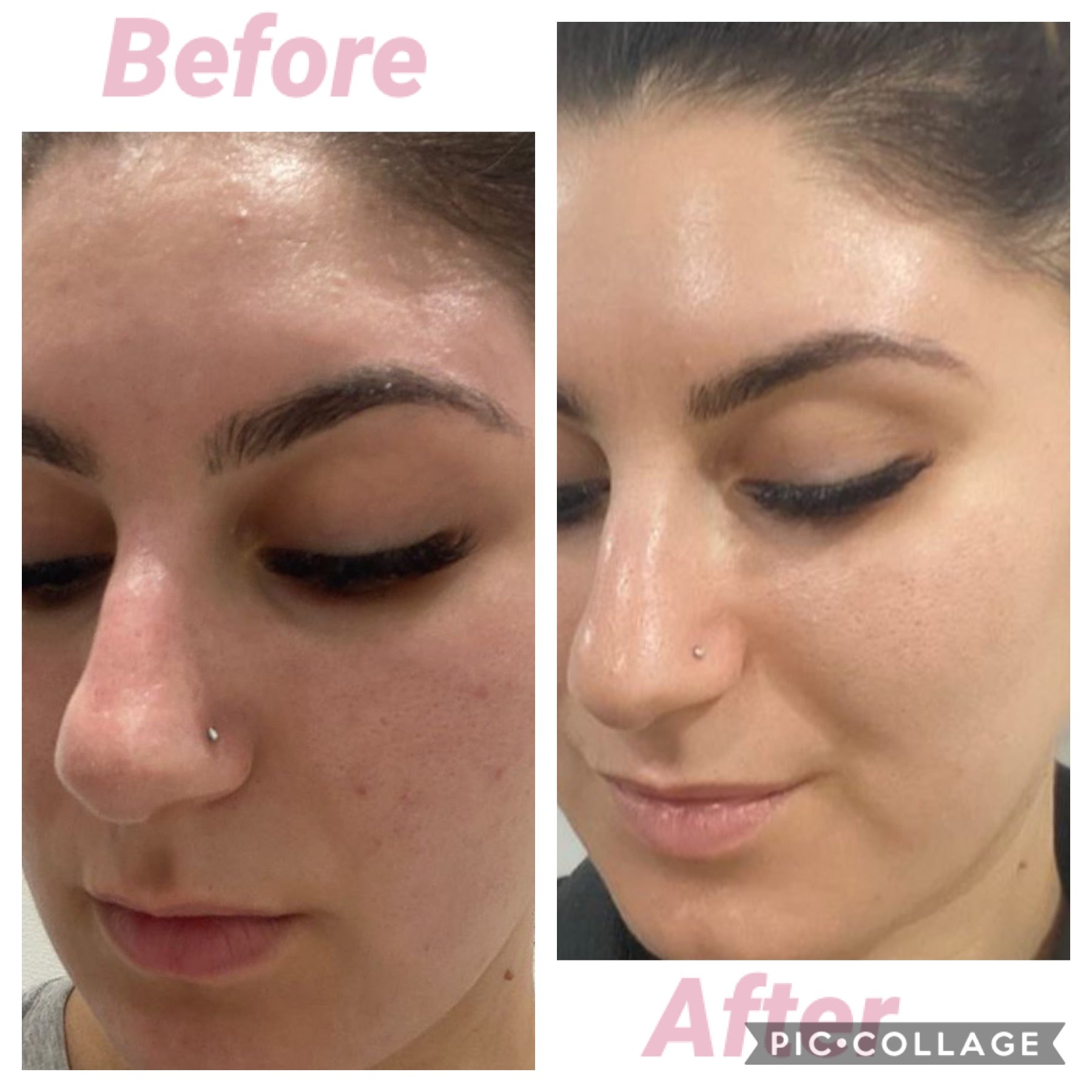 5x Carboxy Korean Facial plus HYDRA deep clean & Led Light