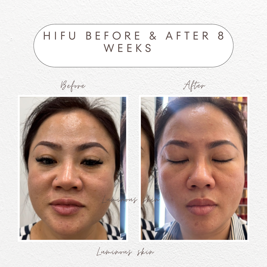 💎 HIFU Skin Tightening: Why It Lifts — Not Melts Fat
