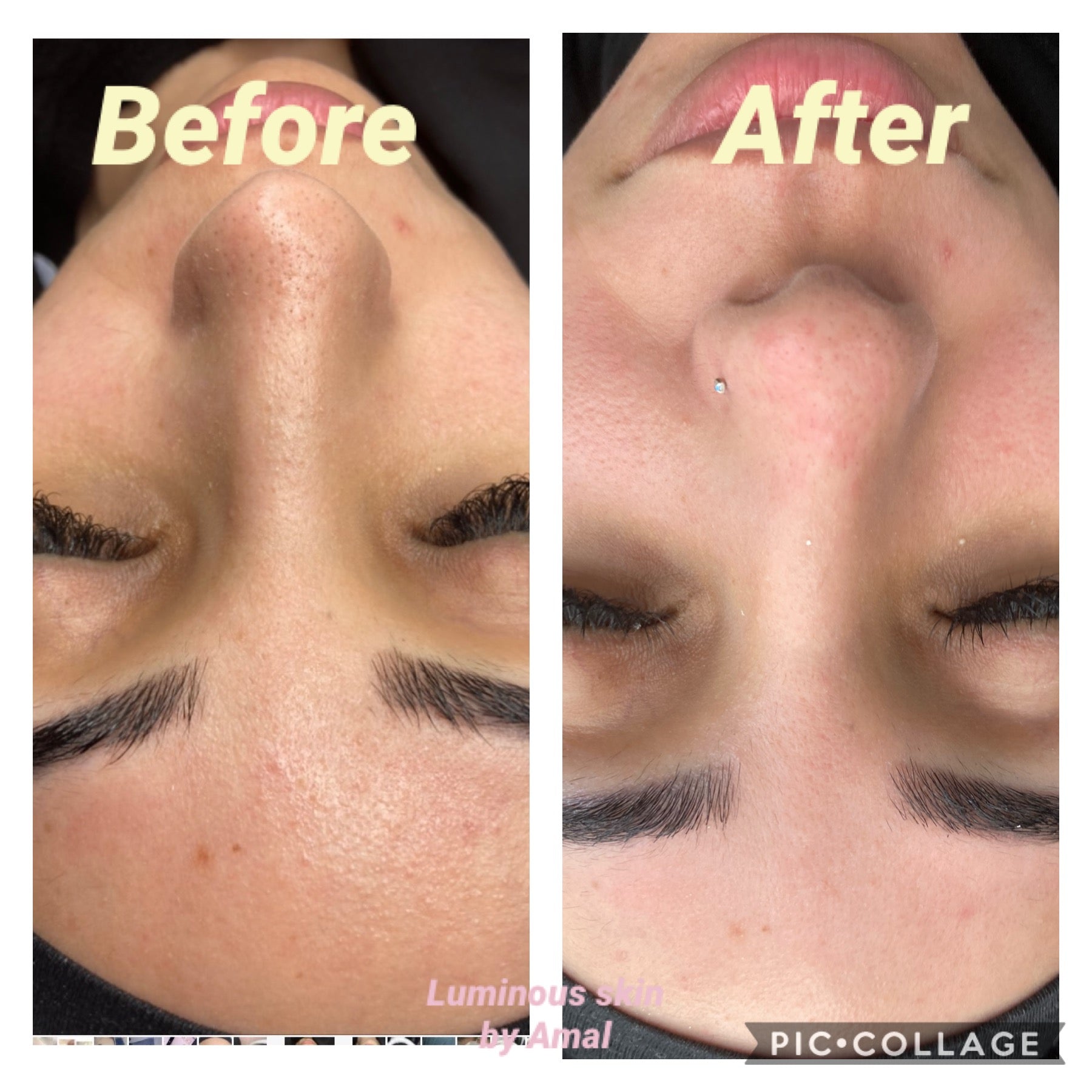 5x Carboxy Korean Facial plus HYDRA deep clean &amp; Led Light