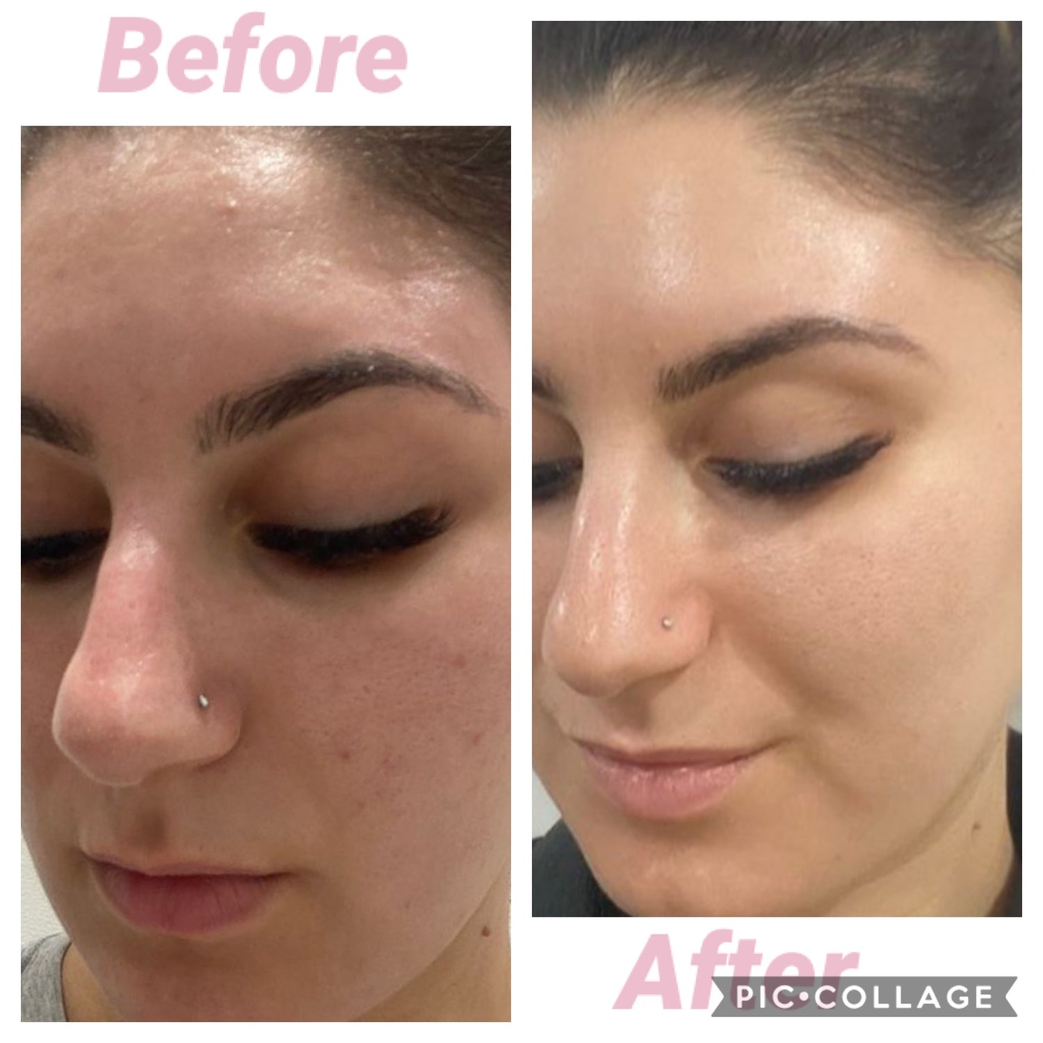 5x Carboxy Korean Facial plus HYDRA deep clean &amp; Led Light