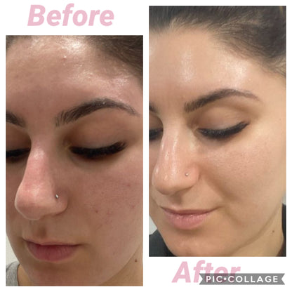 5x Carboxy Korean Facial plus HYDRA deep clean &amp; Led Light