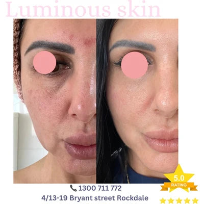HIFU treatment result