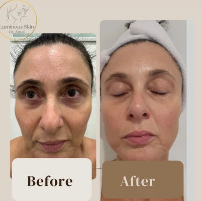HIFU treatment result