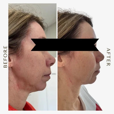 HIFU treatment result